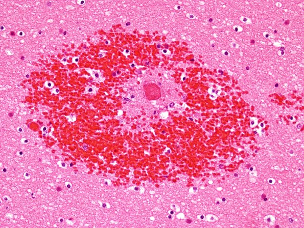 1C6 Infarct, venous, ST & ICV thrombus (Case 1) H&E 2