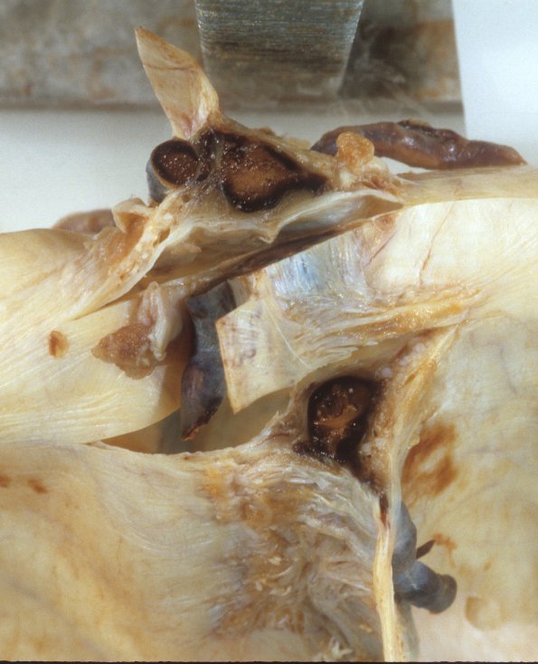 2A1 SSST (Case 2) A12