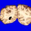 3A1 Infarct, venous (Case 3)  3