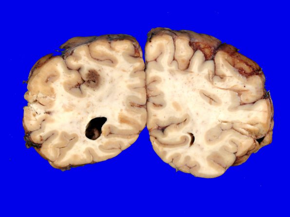 3A1 Infarct, venous (Case 3)  3