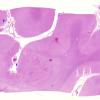 3B1 Infarct, venous (Case 3) H&E WM 6 copy