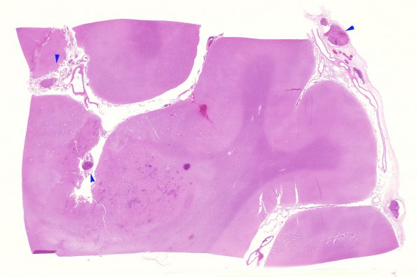 3B1 Infarct, venous (Case 3) H&E WM 6 copy