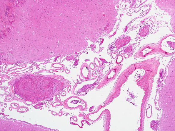 3B2 Infarct, venous (Case 3) H&E 9