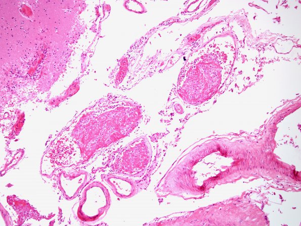3B3 Infarct, venous (Case 3) H&E 8