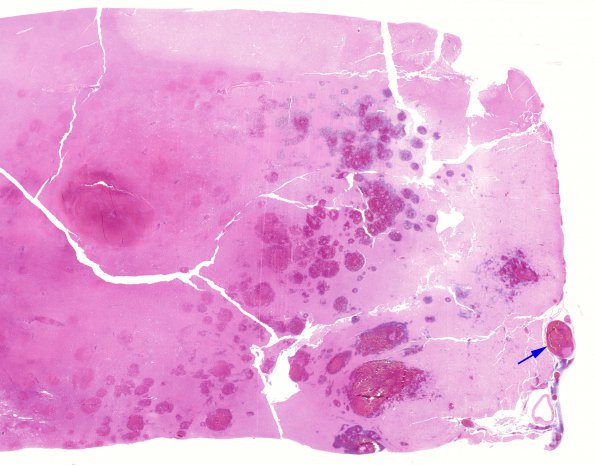 3B4 Infarct, venous (Case 3) H&E WM 4