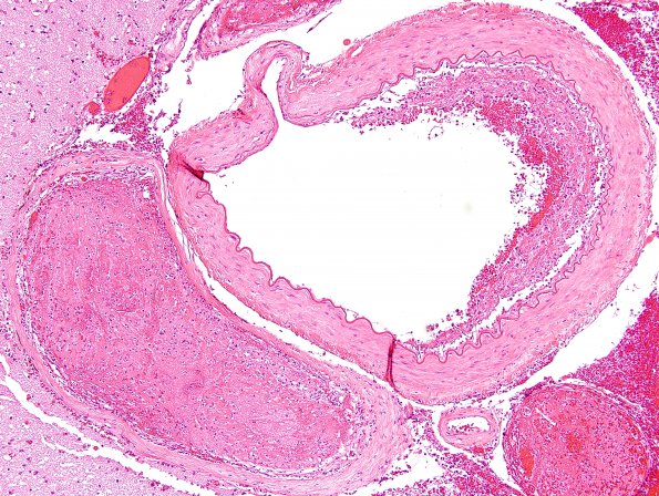 3B6 Infarct, venous (Case 3) H&E 1