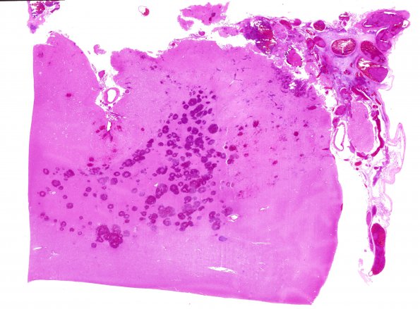 3C1 Infarct, venous (Case 3) H&E WM