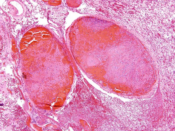 3C3 Infarct, embolic (Case 3) H&E 4