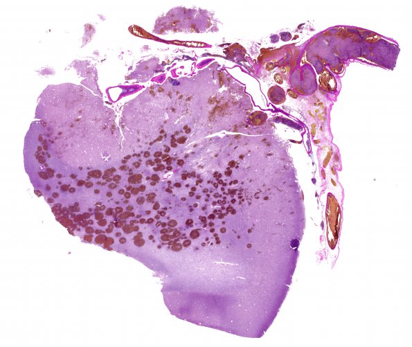 3C4 Infarct, venous (Case 3) N12 VVG WM