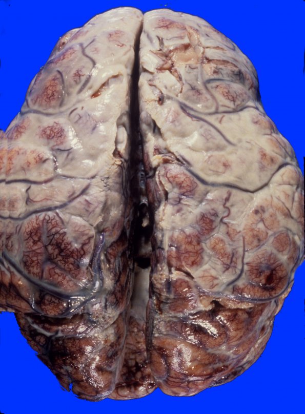 4A1 Meningitis, PC (Case 4) A1