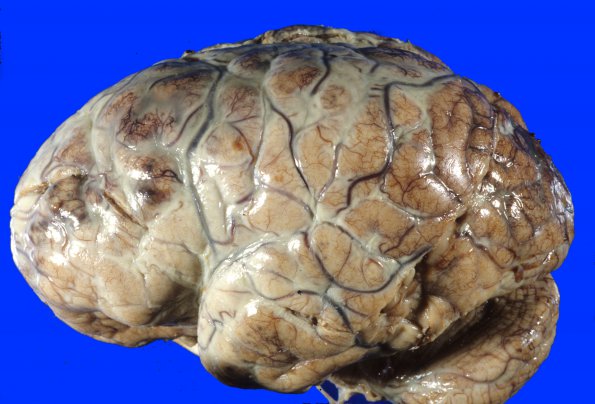 4A2 Meningitis, SSST (Case 4) 2