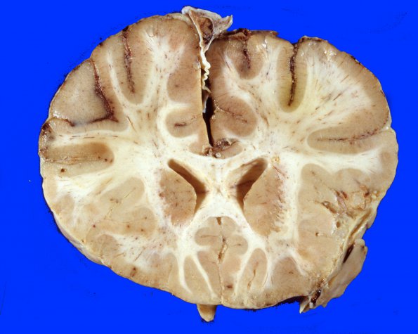 4A3 Meningitis, SSST (Case 4) 1