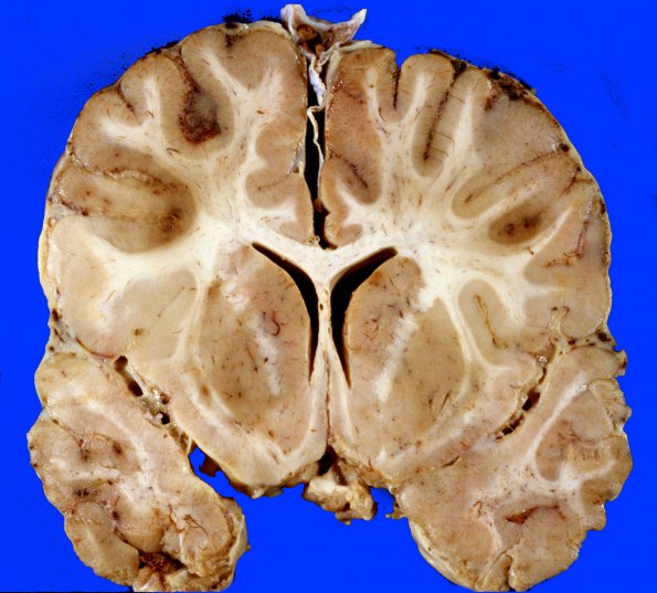 4A4 Meningitis, SSST (Case 4)