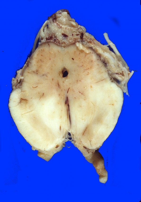 4A6 Meningitis, SSST (Case 4) brainstem infarction