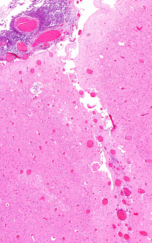 4C2 Meningitis, bacterial (Case 4) H&E 6