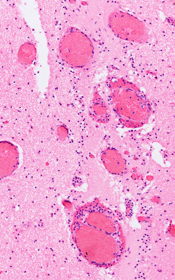 4C3 Meningitis, bacterial (Case 4) H&E 5