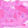 4C4 Meningitis, bacterial (Case 4) H&E 7 copy