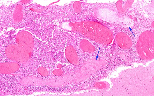 4C4 Meningitis, bacterial (Case 4) H&E 7 copy