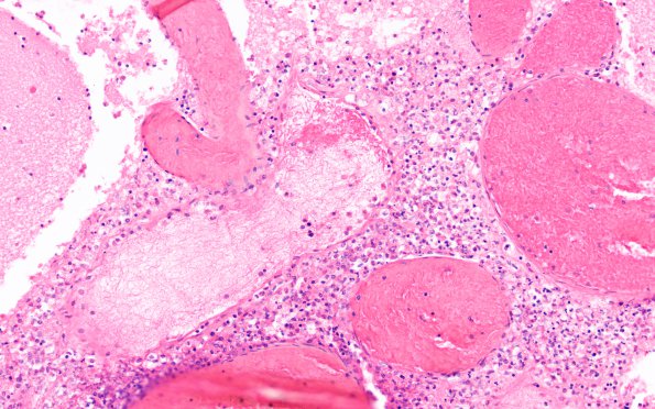 4C5 Meningitis, bacterial (Case 4) H&E 8