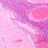 4C6 Meningitis, bacterial (Case 4) H&E 2 copy