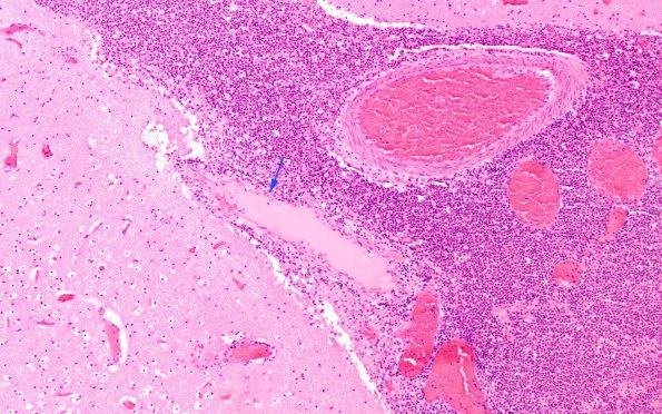 4C6 Meningitis, bacterial (Case 4) H&E 2 copy