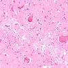 4C7 Meningitis, bacterial (Case 4) H&E 1 copy