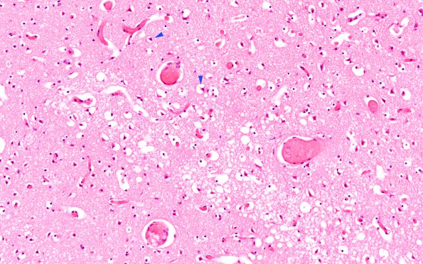 4C7 Meningitis, bacterial (Case 4) H&E 1 copy