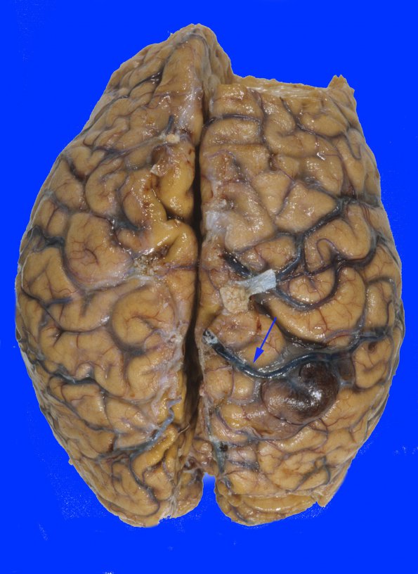 5A1 Infarct, venous, SSST (Case 5) 1 copy