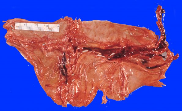 6A1 Superior sinus thrombosis (Case 6) 4