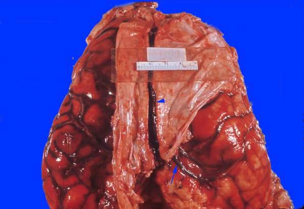 6A2 Superior sinus thrombosis (Case 6) 3 copy