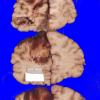 6A3 Superior sinus thrombosis (Case 6) 5