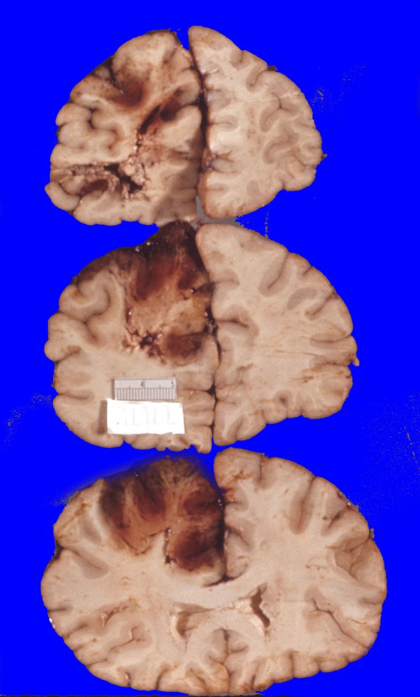 6A3 Superior sinus thrombosis (Case 6) 5