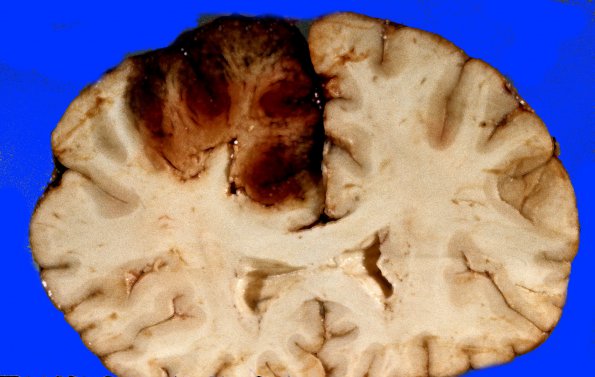 6A4 Superior sinus thrombosis (Case 6) 3