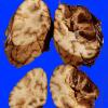 6A5 Superior sinus thrombosis (Case 6) 2 (2)