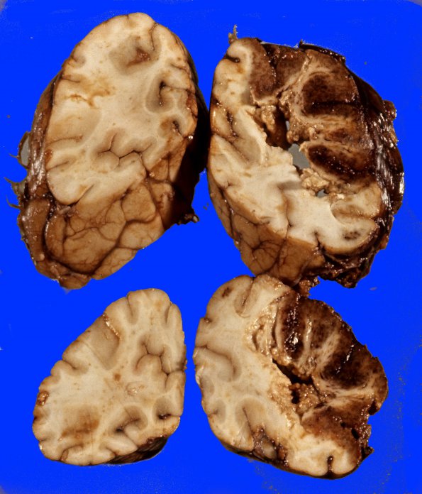 6A5 Superior sinus thrombosis (Case 6) 2 (2)