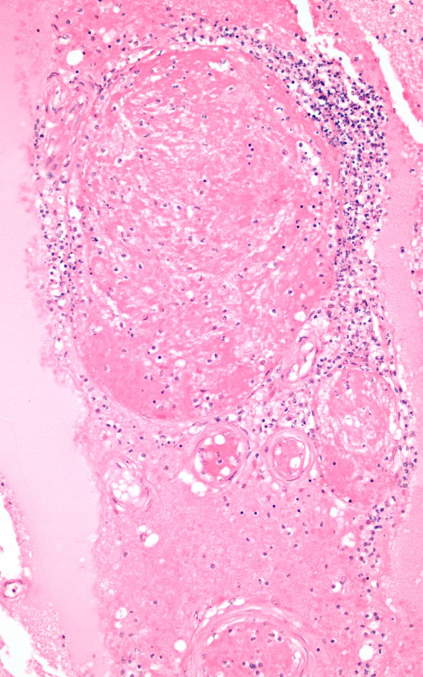 6B2 Superior sinus thrombosis (Case 6) 20X