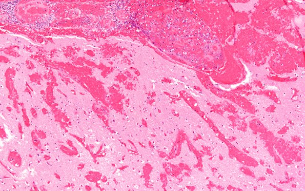 6B3 Superior sinus thrombosis (Case 6) 20X 2