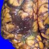 7A1 Infarct, venous (Case 7) 7