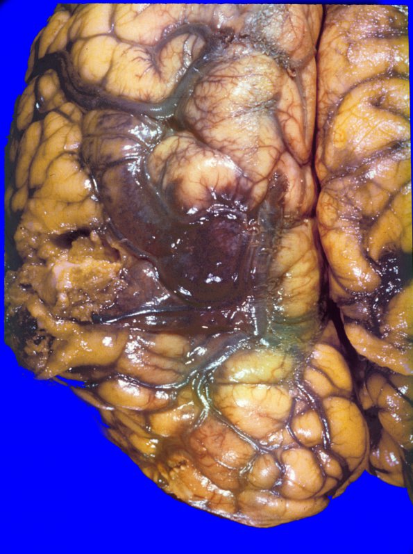 7A1 Infarct, venous (Case 7) 7