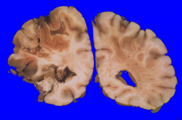 7A2 Infarct, venous (Case 7) 3