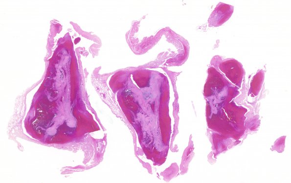 7B1 Infarct, venous (Case 7) SSST