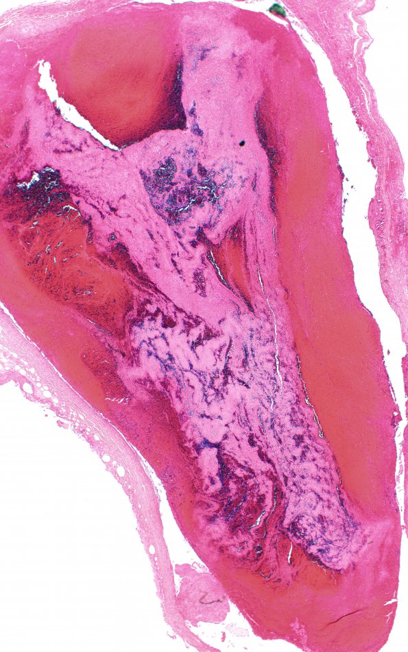 7B2 Infarct, venous (Case 7) SSST H&E 2X