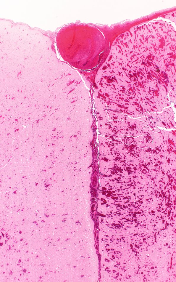 7C1 Infarct, venous (Case 7) H&E 2X