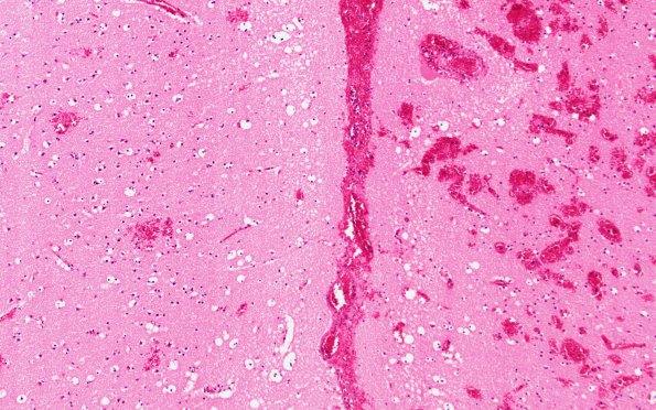 7C2 Infarct, venous (Case 7) H&E Both sides