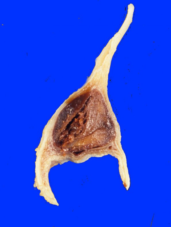 8A1 Infarct, venous SSST & cortical veins (Case 8) 2