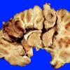 8A2 Superior sinus thrombosis (Case 8) 1