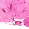 8B3 Herniation, uncal, following SSST (Case 8) N13 2X