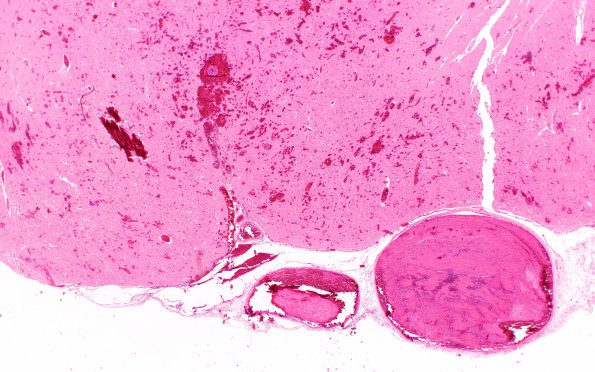 8B3 Herniation, uncal, following SSST (Case 8) N13 2X