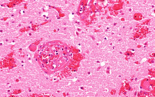 8B4 Herniation, uncal, following SSST (Case 8) N14 1