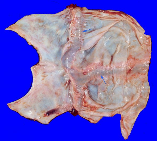 9A1 Thrombosis, SSST & TV sinuses (Case 9) 1 copy